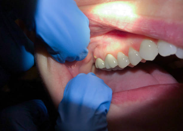 Best Emergency Treatment for Dental Infections or Abscesses in Manchester, WA